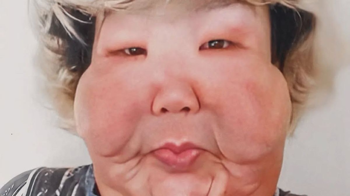 Juju do Pix realiza a primeira cirurgia após ter rosto deformado