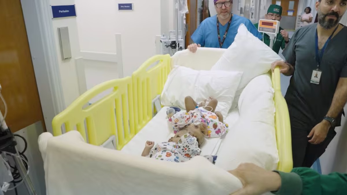 Mercy e Goodness ainda unidas a caminho da cirurgia de separação Mercy e Goodness ainda unidas a caminho da cirurgia de separação