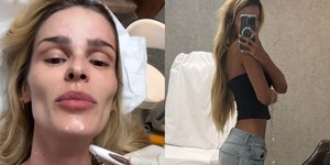 Yasmin Brunet põe botox e renova preenchimento no bumbum