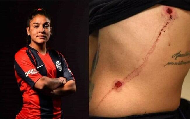 Jogadora Rocio Correa postou uma foto com as marcas das balas de borracha