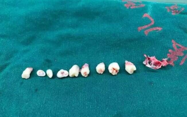 Médicos encontram dentes no cérebro de criança de 5 anos, após detectarem um tumor Médicos encontram dentes no cérebro de criança de 5 anos, após detectarem um tumor