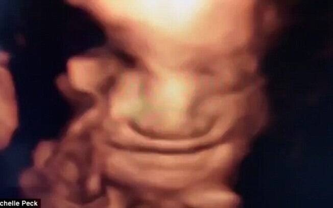 Durante o ultrassom, o bebê abriu um sorriso e os pais ficam encantados com a imagem 