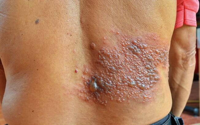 Caso de herpes zóster nas costas; doença, conhecida popularmente como cobreiro, também pode surgir no rosto