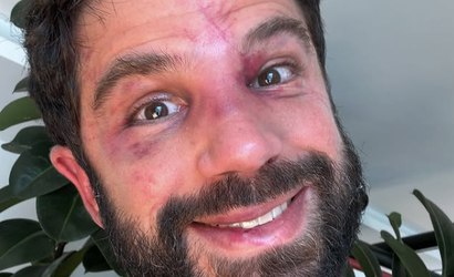 Duda Nagle mostra hematomas no rosto após combate com Popó