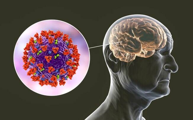 Estudos iniciais indicam que Covid-19 pode desencadear Alzheimer
