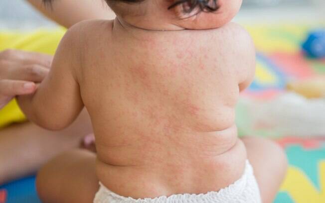 A roséola é uma infecção viral em que a criança apresenta febre, manchas vermelhas pela pele e outros sintomas