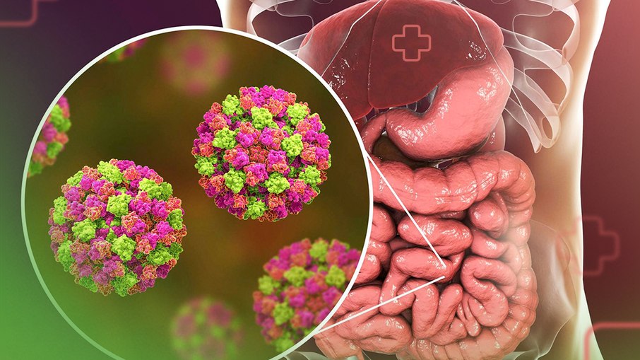 O norovírus é um vírus altamente contagioso que se espalha na água e alimento contaminado
