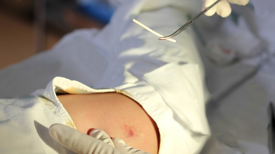 Implante contraceptivo Implante contraceptivo