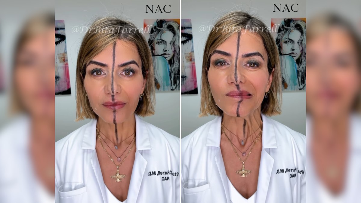 Médica aplica botox em metade do rosto e choca com resultado Médica aplica botox em metade do rosto e choca com resultado