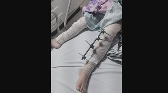 Médicos operam perna errada de menina de 6 anos na Paraíba