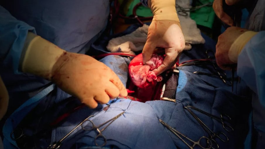 Dois pacientes recebem corações de porcos geneticamente modificados nos EUA em transplantes bem-sucedidos