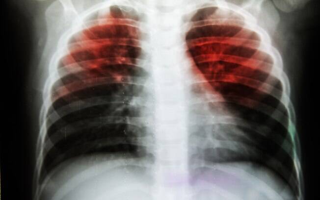 Para detectar a doença é necessário uma  radiografia de tórax e de testes da secreção respiratória para identificação da bactéria 