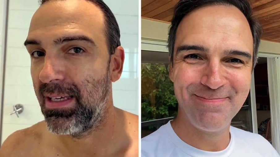 Tadeu Schmidt Confessa Implante Capilar Após Pressão Divertida de Ana Maria Braga