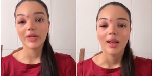 Jovem desenvolve celulite ocular após espremer espinha; entenda