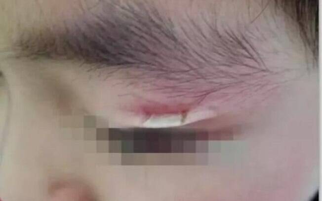 oftalmologista Liu Xiang expôs que menino não identificado podia ter sofrido danos maiores, mas que atualmente passa bem 