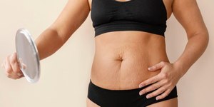 Diástase abdominal: Quando a barriguinha só some com cirurgia