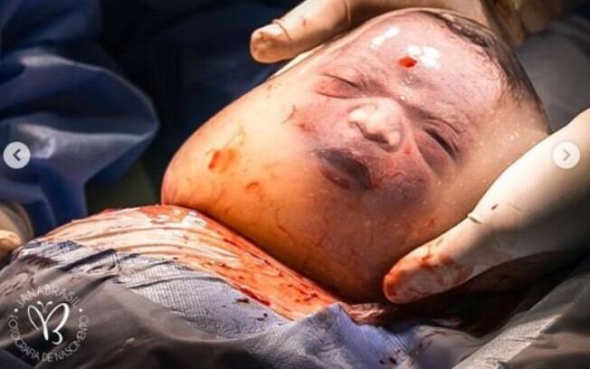 Janaina Brasil, fotografa especializada em nascimento de bebês, clicou e compartilhou as fotos do parto empelicado 
