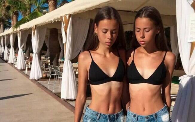 Antes de desenvolver anorexia, as gêmeas estavam em busca da carreira de modelo, quando ouviram que precisavam emagrecer