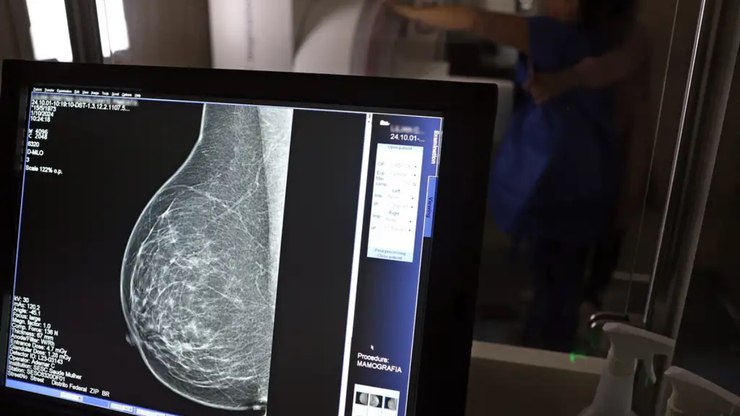 Mamografia no SUS passa a ser oferecida a partir dos 40 anos