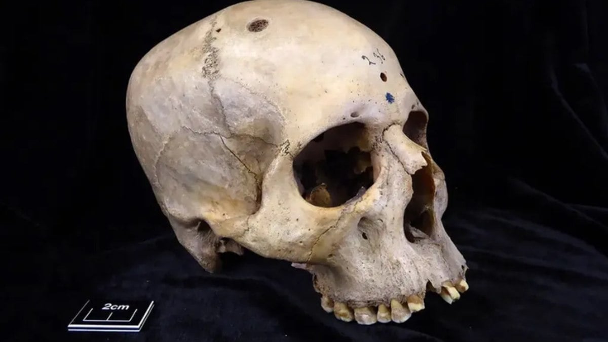 Crânio de 4 mil anos revela como os egípcios tratavam câncer cerebral