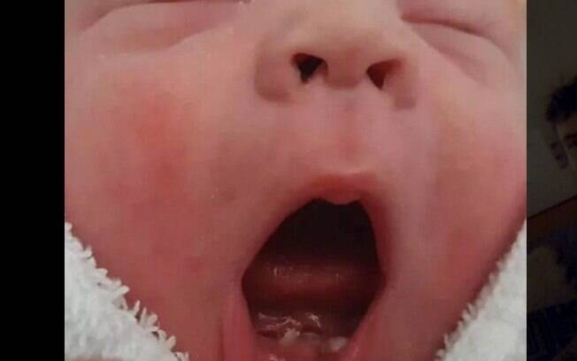 Mãe só percebeu que sua bebê havia nascido com dentes depois de alimentá-la