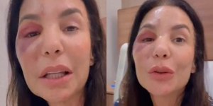 Ivete Sangalo revela que quebrou ossos da face e detalha cirurgia