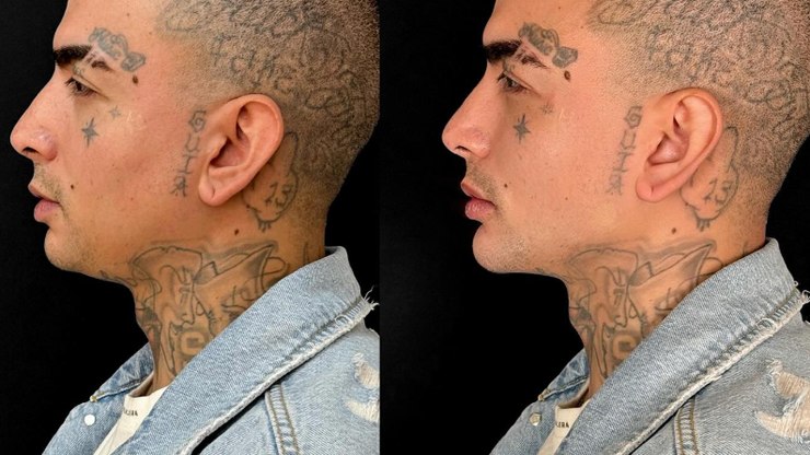 MC Guimê surpreende ao mostrar antes e depois de harmonização