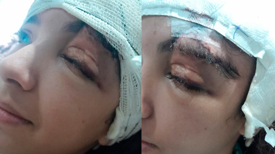 Adolescente de 14 anos foi a primeira paciente da rede pública de Goiás a passar por uma cirurgia de remodelação óssea craniana Adolescente de 14 anos foi a primeira paciente da rede pública de Goiás a passar por uma cirurgia de remodelação óssea craniana