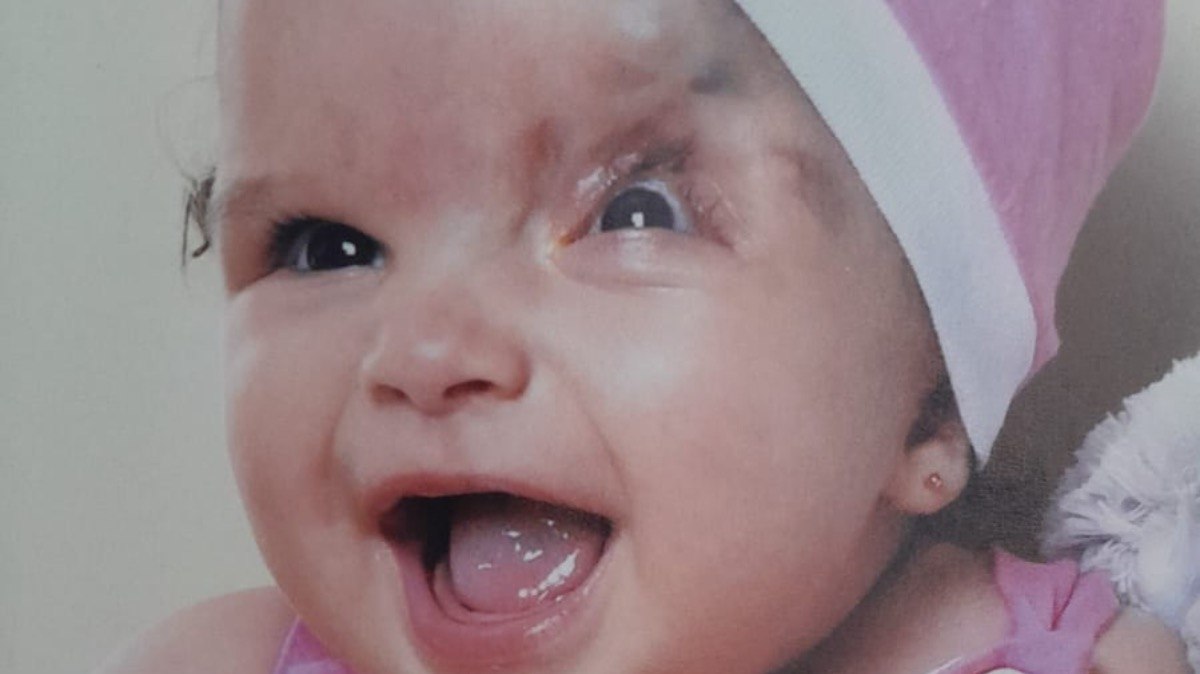 Beatriz nasceu com malformação craniofacial e sem a pálpebra esquerda