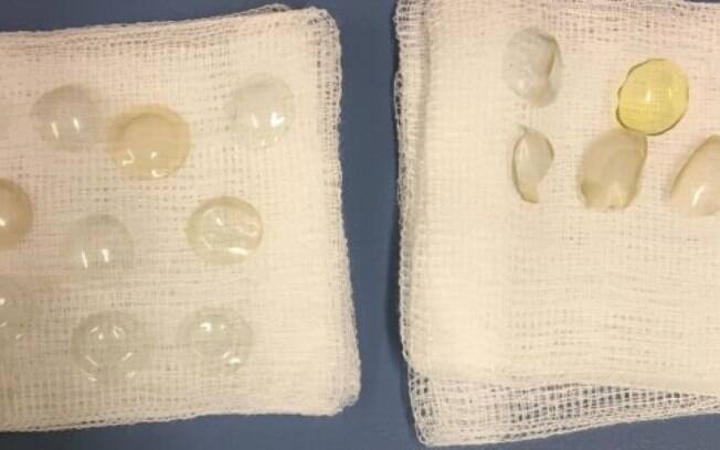 Quase 30 lentes de contato foram encontradas no olho de uma idosa na Inglaterra