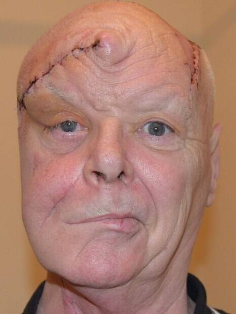 Britânico Colin Davies passou por reconstrução facial após  câncer de pele
