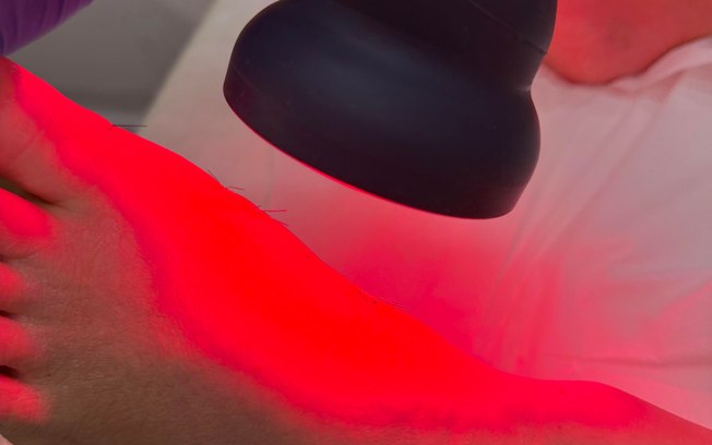 Laser de alta intensidade auxilia no controle da dor