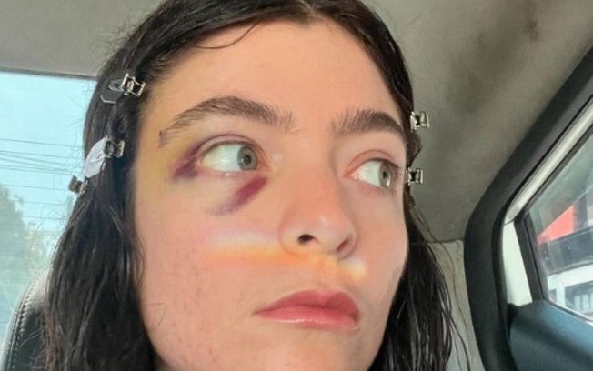 Lorde aparece com olho roxo em novas fotos e fãs ficam curiosos