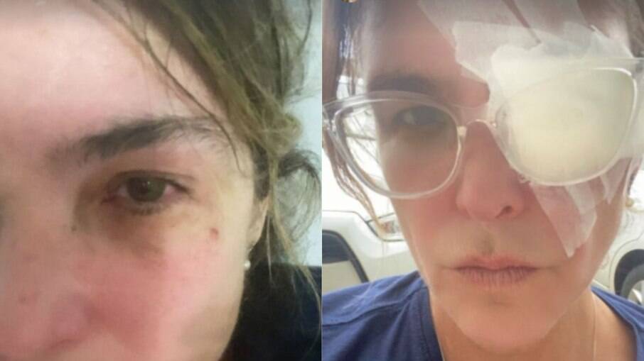 Cristiana Oliveira machuca o olho
