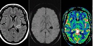 Vacina é a nova esperança contra tumores cerebrais