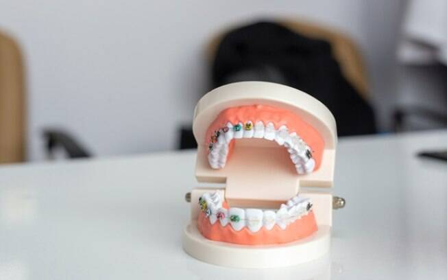 Problemas de oclusão dentária atingem mais da metade das crianças