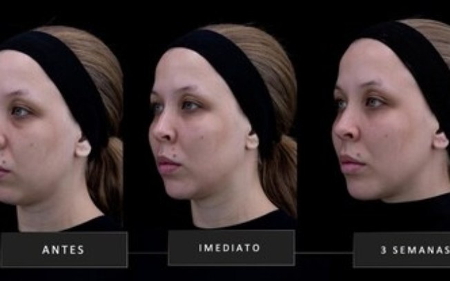 Galderma apresenta Restylane® ShaypeTM, a próxima geração de ácido hialurônico injetável Galderma apresenta Restylane® ShaypeTM, a próxima geração de ácido hialurônico injetável