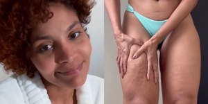 Barbara Reis chora ao ver resultado de cirurgia contra lipedema