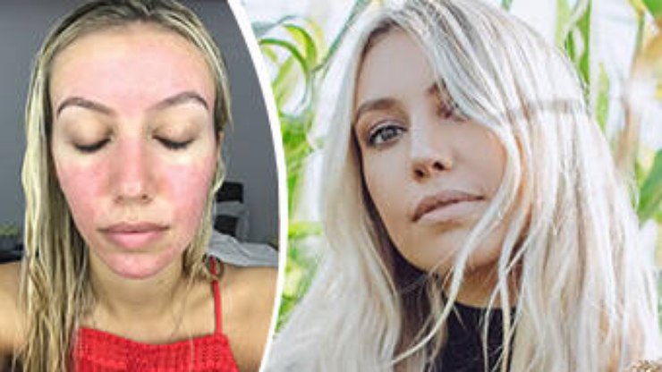 Rosácea: a inflamação que vai além da pele.