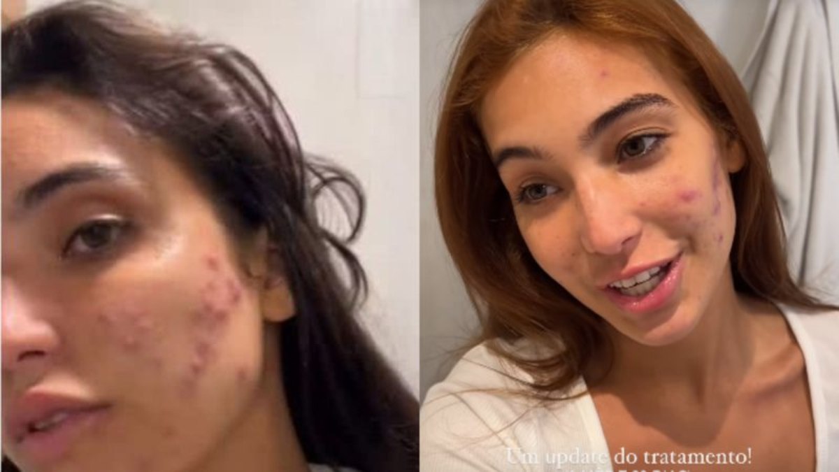 Vanessa Lopes mostra tratamento contra acne