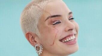 Modelo inspira ao assumir cicatrizes: 