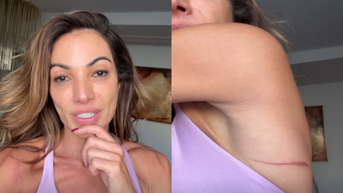 Patrícia Poeta mostra hematomas após Carnaval Patrícia Poeta mostra hematomas após Carnaval