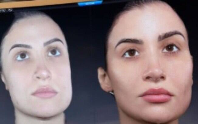 Bianca Andrade mostra antes e depois de procedimentos estéticos