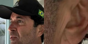 'Sinal de Frank' no lóbulo da orelha e o infarto: qual a relação?