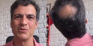 Mateus Solano sobre assumir calvície na TV: 'Minha careca faz parte'