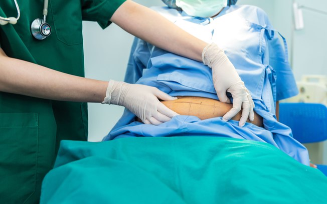 Bariátrica por videolaparoscopia permite melhor recuperação Bariátrica por videolaparoscopia permite melhor recuperação