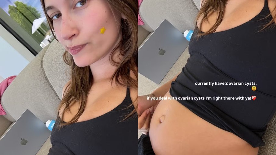 Hailey Bieber revela dois cistos no ovário