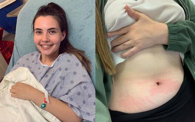 A estudante Tessa Hansen-Smith, de 21 anos, sofre com urticária aquagênica, doença rara que causa alergia à água