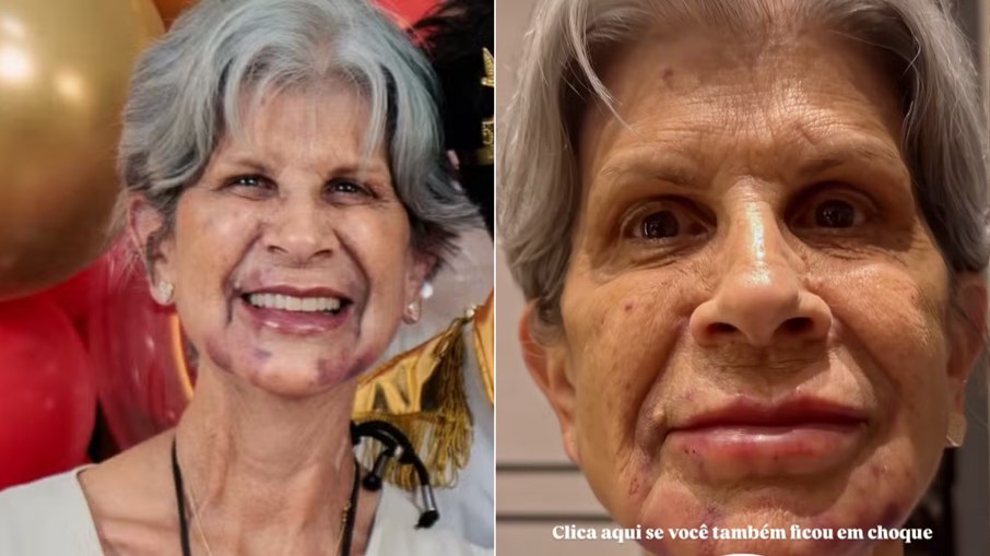 Inchaço e roxos após a harmonização facial são comuns e geralmente desaparecem em alguns dias Inchaço e roxos após a harmonização facial são comuns e geralmente desaparecem em alguns dias