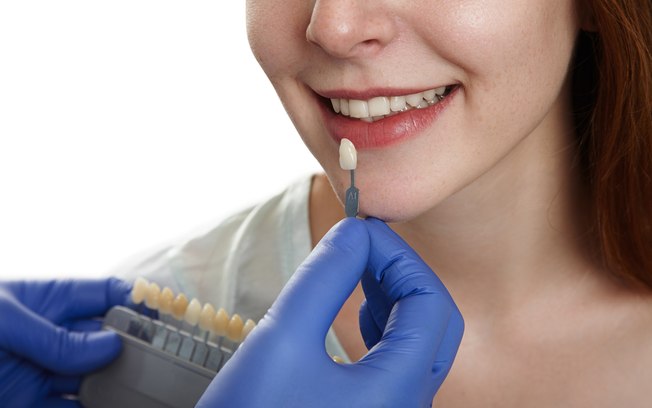 Facetas dentárias precisam de boa higiene bucal